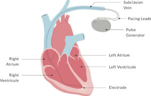 Diagram of a dual-chamber / double lead pacemaker with key parts labelled